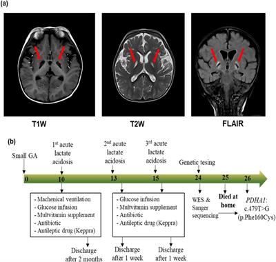 Case Report: A novel hemizygous missense PDHA1 variant in a Vietnamese boy with pyruvate dehydrogenase E1-alpha deficiency